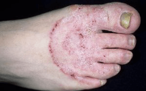 Razlogi za pojav glive na nogah