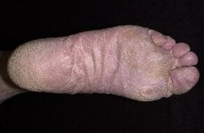 Znaki in simptomi glive na nogah