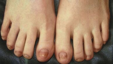 Stopnje razvoja gliv nohtov