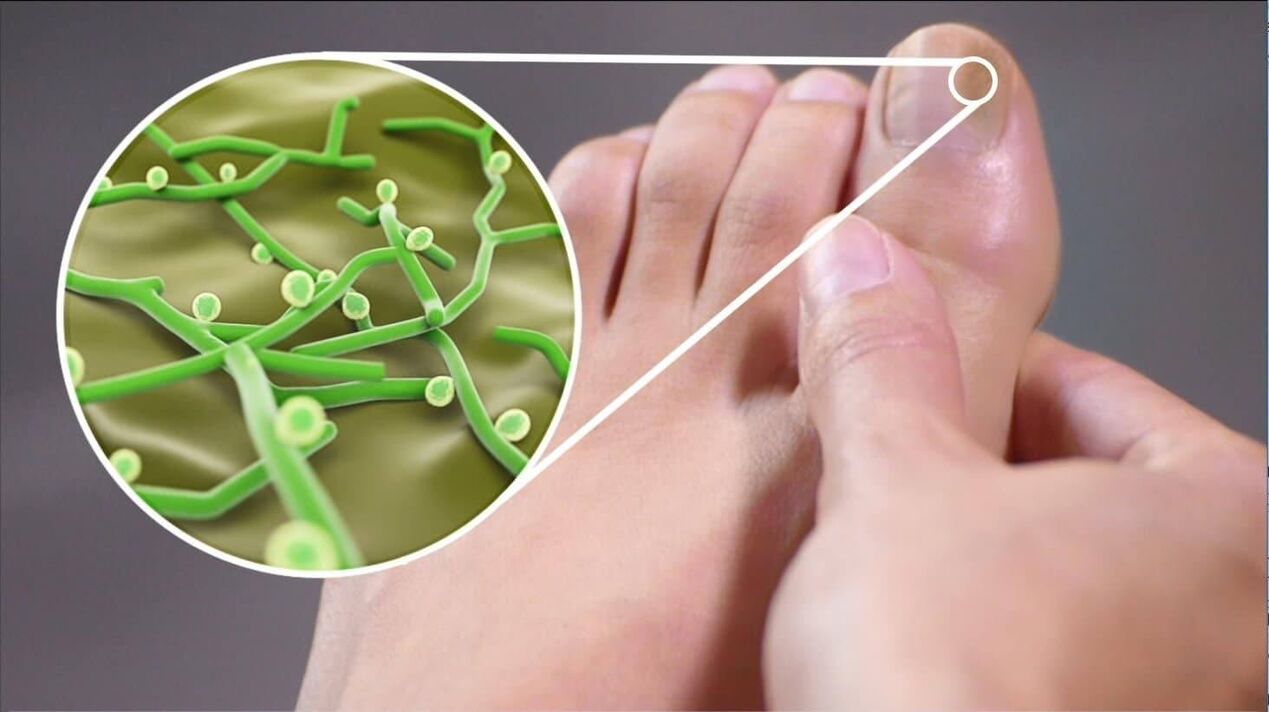 povzročitelji glivic na nohtih