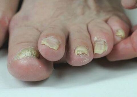 zdravljenje glivic na nohtih z zdravili