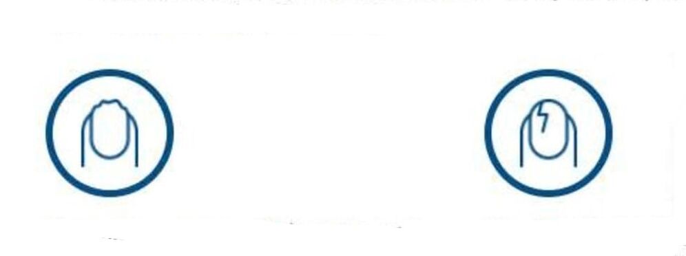 deformacija nohtov zaradi glivične okužbe