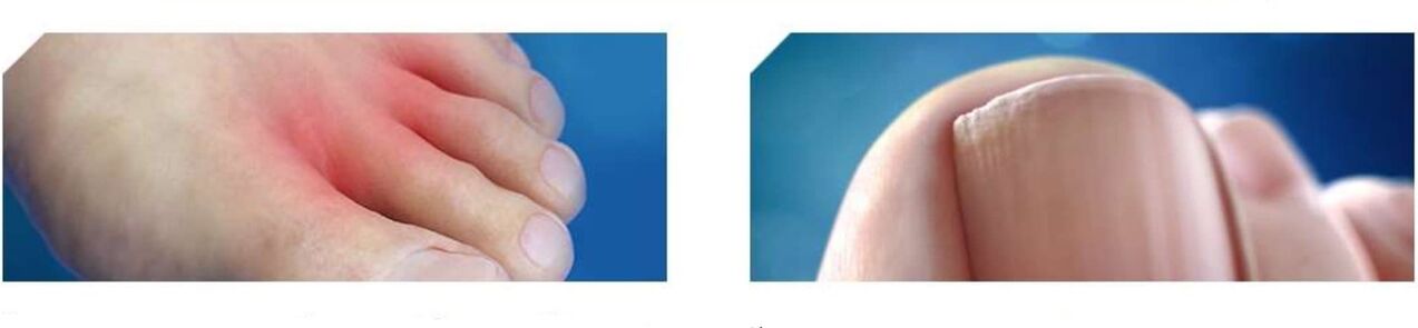 začetna stopnja glivic na nogah